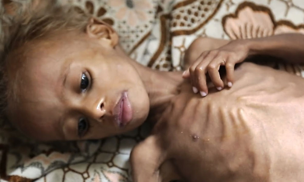 Yemen’de 85 bin çocuk açlıktan öldü!