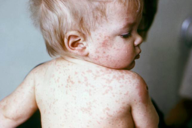 Aşı karşıtlığı arttı: Kızamık salgını alarmı verildi! Büyük bölümü çocuk…