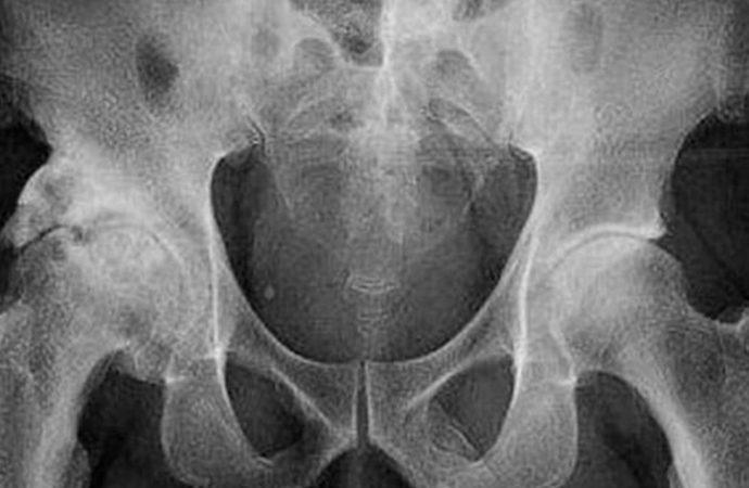 Nadir görülen bir hastalık… 63 yaşındaki adamın penisi kemikleşmeye başladı!