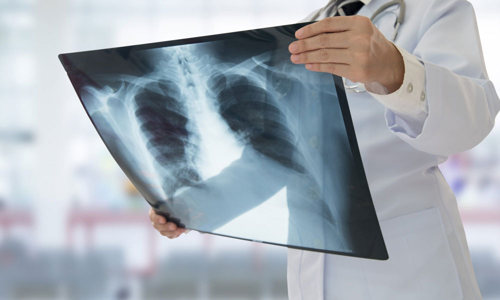 Buzlu cam benzeri yapılar…  İyileşen korona hastalarının akciğerlerinde şoke eden bulgular