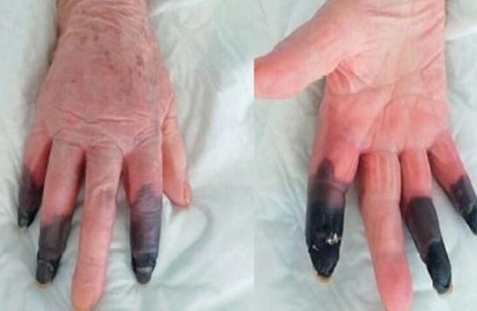 Koronavirüse yakalanan kadının parmakları kesildi