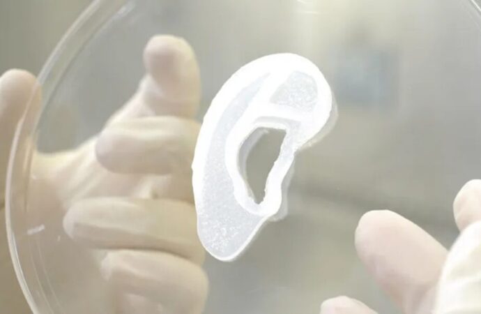 3D yazıcı ile yapılan kulak, hastaya nakledildi