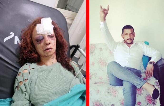 Erkek arkadaşı Hasan Sevincer’in sopa ile dövüp bıçakladığı Rahime 5 gündür yoğun bakımda!