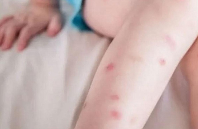 Sivrisineklerin sizi ısırmasının nedeni kullandığınız sabun olabilir