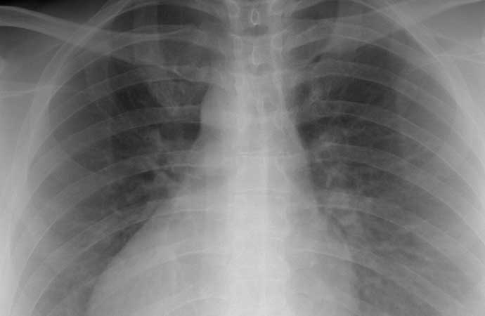 Asbestin neden olduğu Mezotelyoma: Tehlikeli bir hastalık