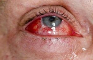 Kırmızı göz hastalığı yayılıyor! İşte korunmak için yapılması gerekenler