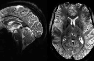 Dünyanın en güçlü MRI cihazıyla çekildi! İşte insan beyninin en net görüntüsü