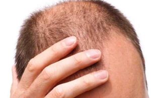 Saç dökülmesine karşı neler yapılmalı? Müdderisoğlu yanıtladı
