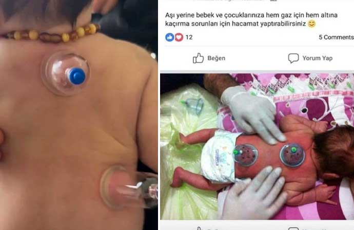İstanbul Tabip Odası, sosyal medyada son günlerde hızla yayılan bebek ve çocuklara yönelik hacamat uygulamasıyla ilgili açıklama yaptı. Ebeveynleri uyaran Tabip Odası, söz konusu uygulamanın sağlığa zararlı olduğunu belirtti.